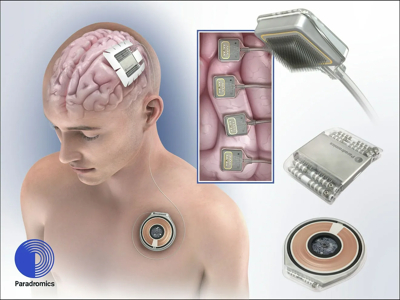 Paradromics Sukses Implantasi BCI pada Manusia, Siap Bersaing dengan Neuralink
